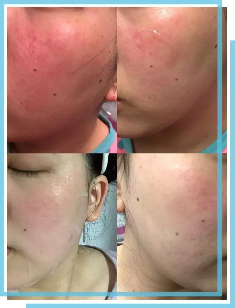 如何有效的祛痘印医美面膜,消炎祛痘的医美面膜