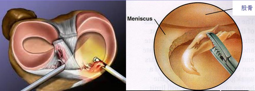 半月板损伤康复训练,半月板损伤膝盖疼的最好治疗方法