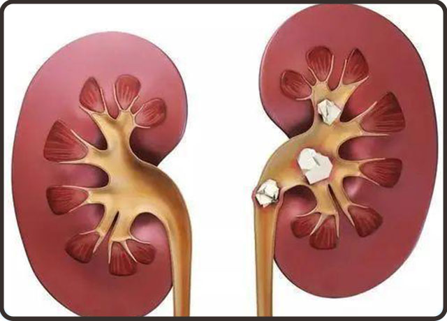 痛风性肾病该如何保养?痛风怎样预防?