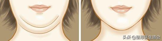 去除双下巴和颈部脂肪手术,手术去除下巴赘肉最有效的方法