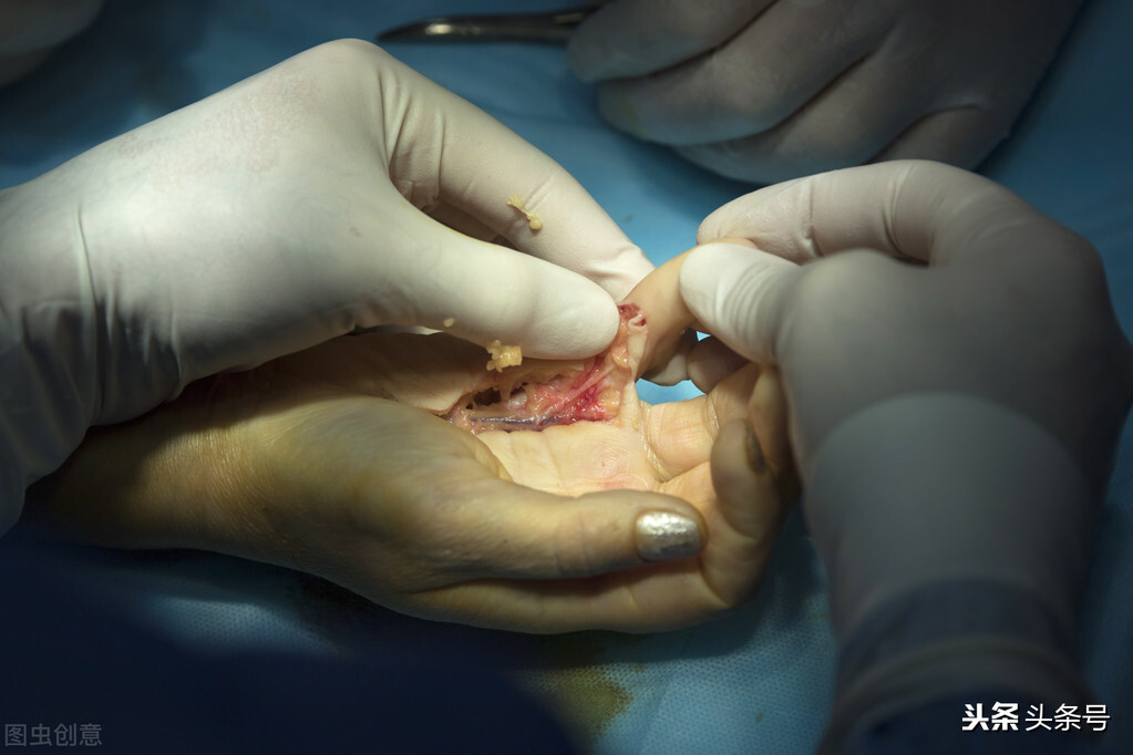 肌腱吻合术后拆线,肌腱吻合术医疗事故