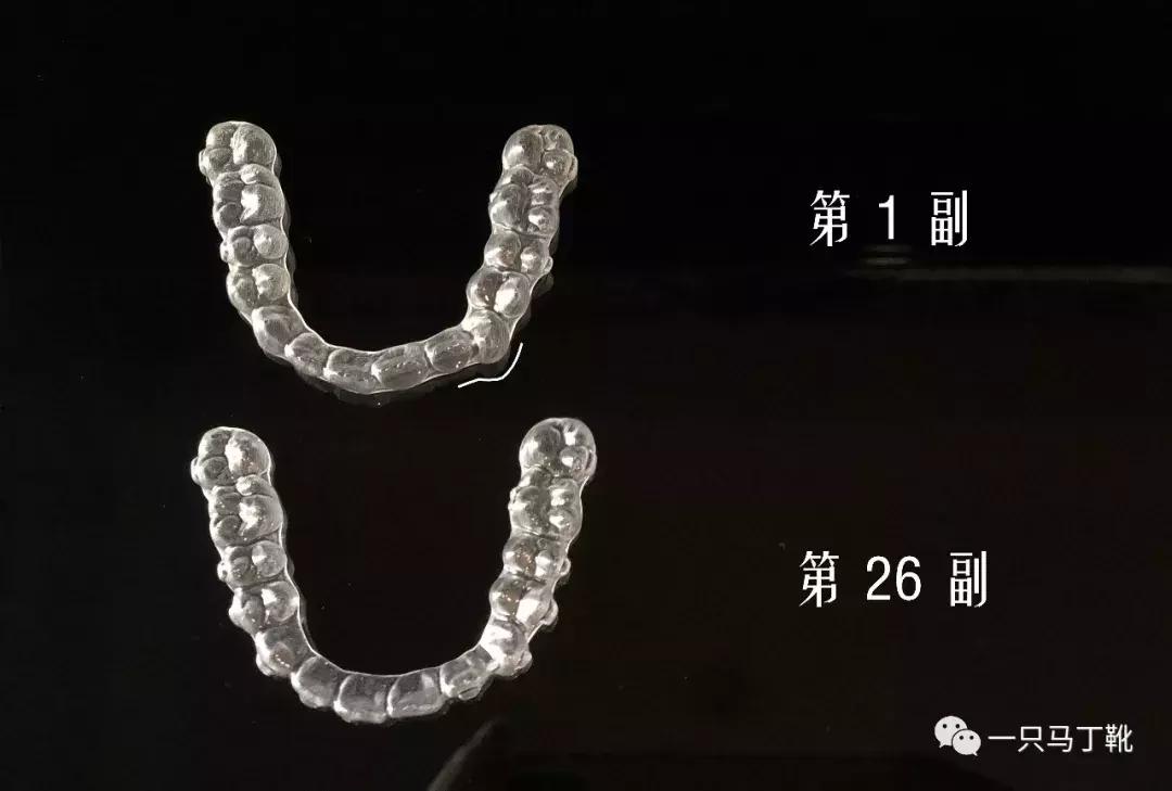 为了变美去整容,整牙堪比整容聊聊我的亲身经历