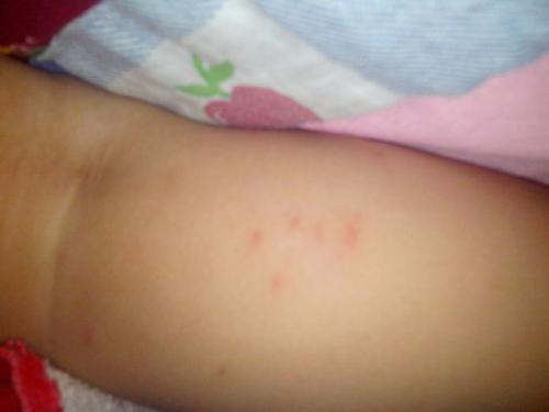 宝宝湿疹反复发作被折磨的睡不着,宝宝湿疹妈妈需要干预吗