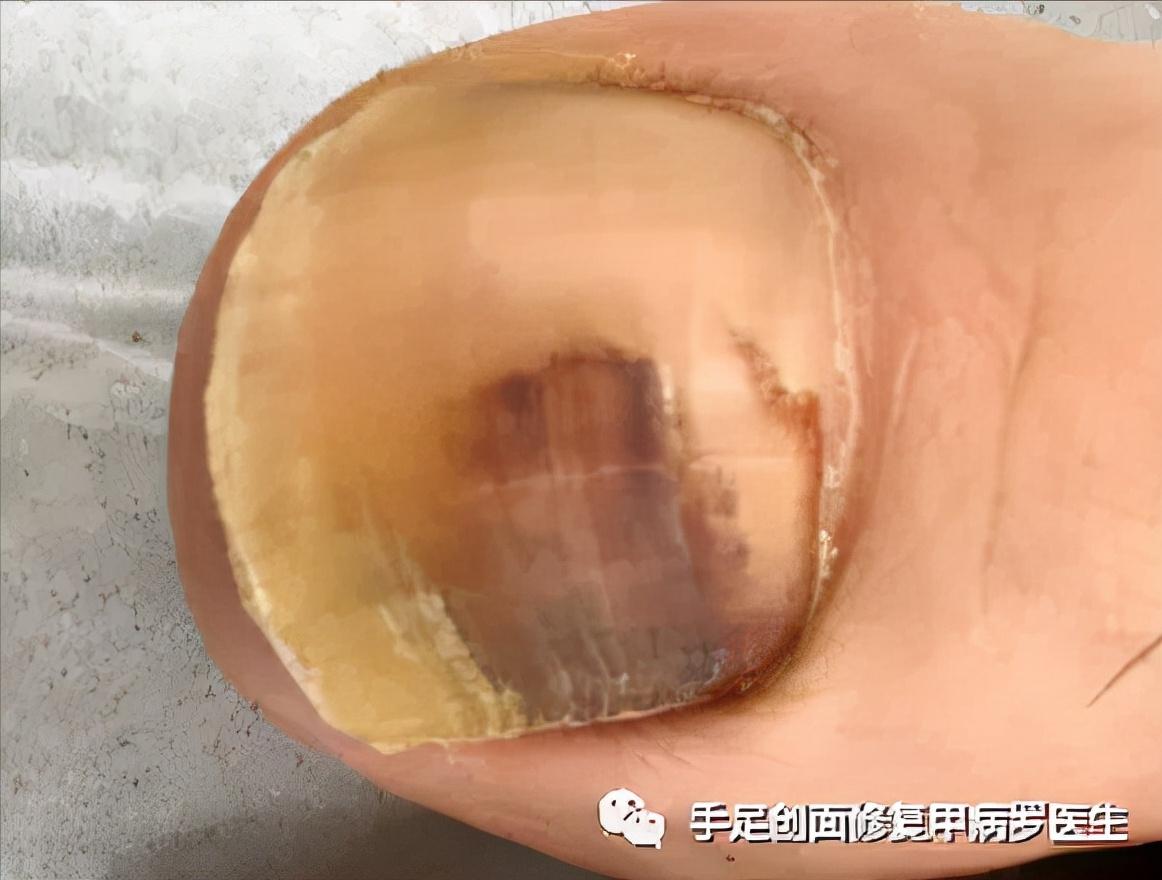 甲下积血怎么处理,甲下积血不排血会胀痛吗