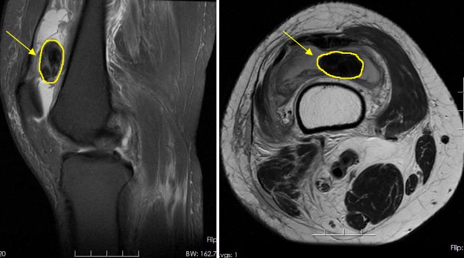 膝关节外侧肿胀且反复发作,神秘原因导致单侧膝关节反复肿胀