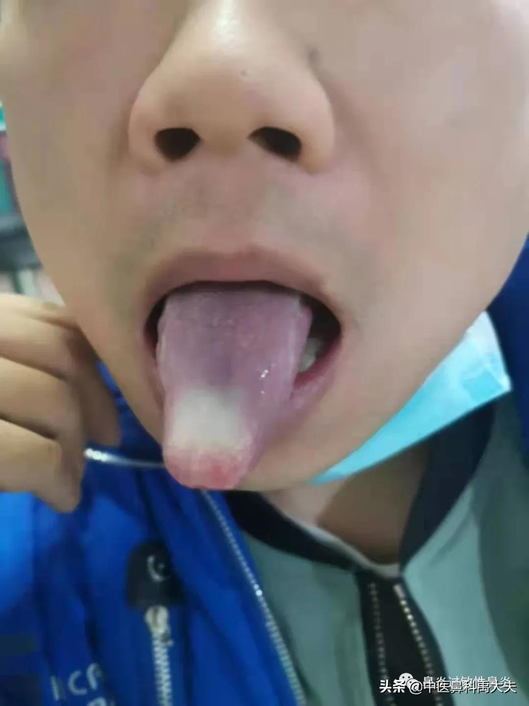 鼻炎的症状和治疗最好方法,常见萎缩性鼻炎或干燥性鼻炎症状