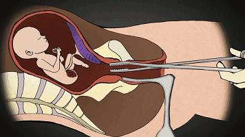 打胎有多可怕案例,20岁女生堕胎7次