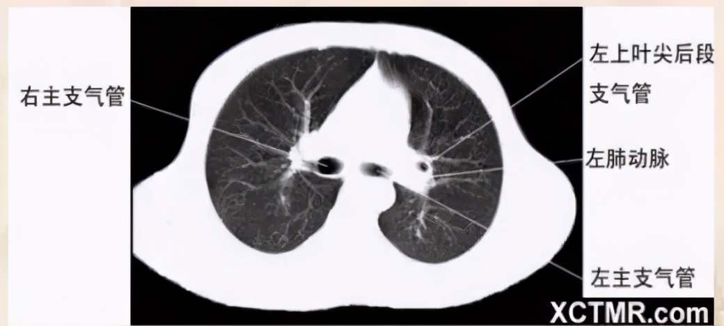 女性盆腔ct断层解剖结构图,女性盆腔脏器ct解剖