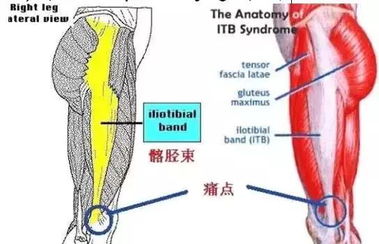 这个伤让他连续三年无缘马拉松！其实1/10的跑者都在被它折磨！