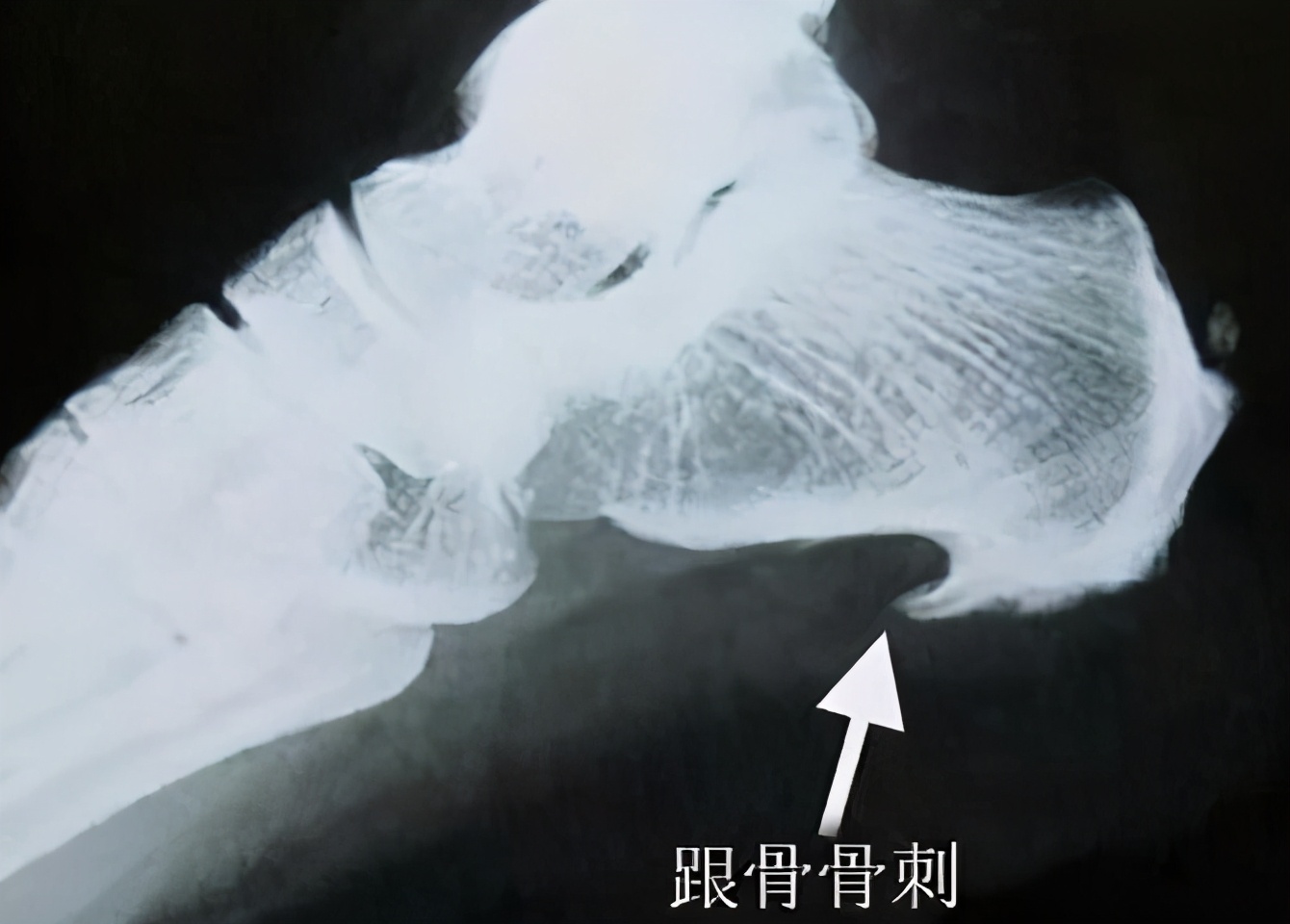 足底筋膜炎康复锻炼单脚跳,足底筋膜炎康复训练视频大全