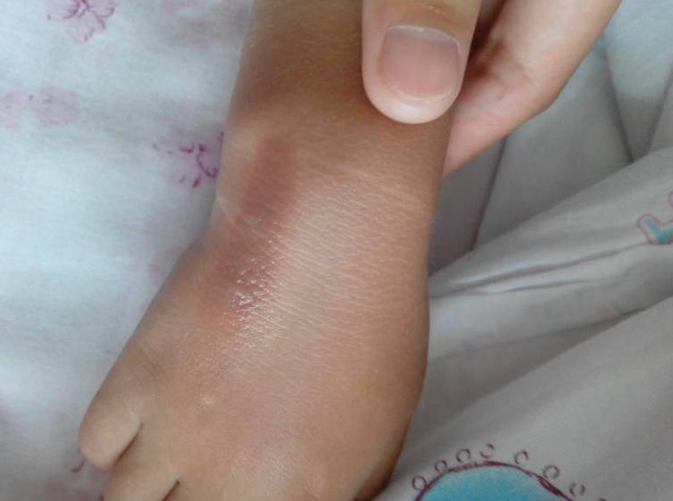 宝宝被蒸汽烫红了怎么办,宝宝被热水烫着了怎么办
