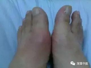 中医角度痛风的病因是什么,中医如何认识痛风