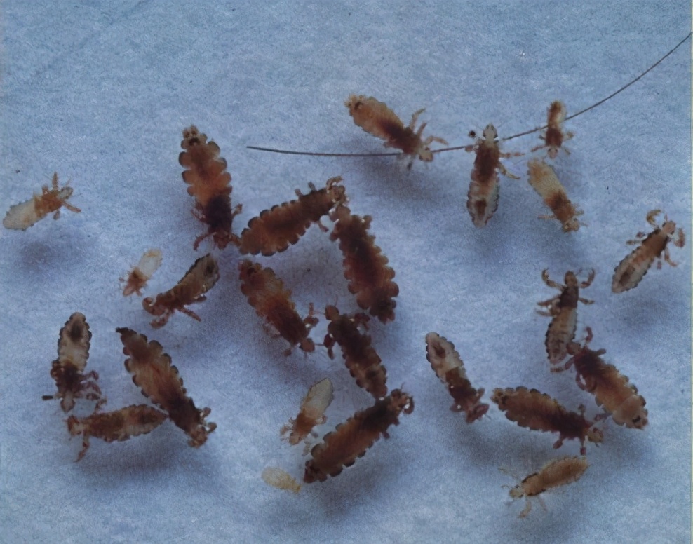 几十年前的农村几乎身上都有虱子,30年前的农村几乎人人都有虱子