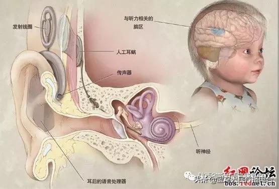 全国爱耳日测听力,植入人工耳蜗手术要多长时间