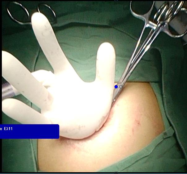 山东医专第一附属医院成功开展首例单孔腹腔镜阑尾切除术