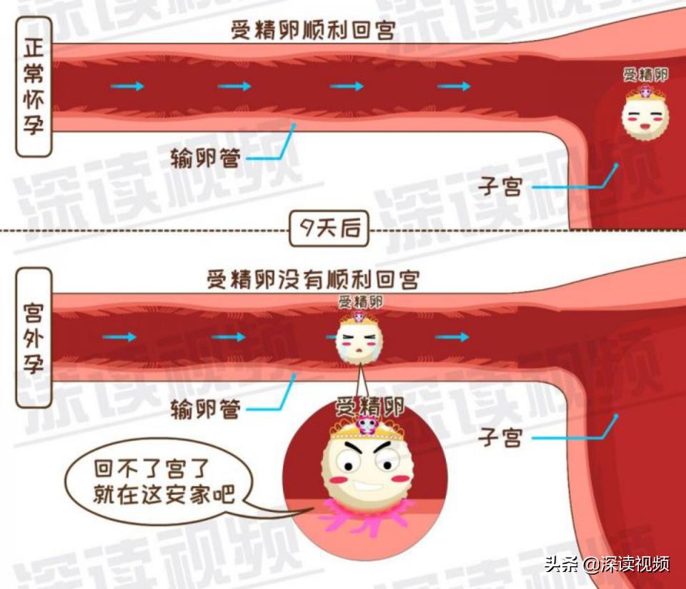 宫外孕还来大姨妈怎么回事,陈旧性宫外孕是怎么回事