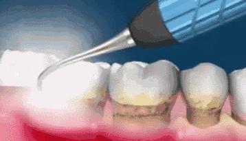 有肾病的人得了牙周炎怎么办,得了牙周炎用什么牙膏刷牙最好