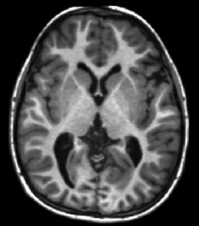脑成像,脑成像技术是什么研究方法