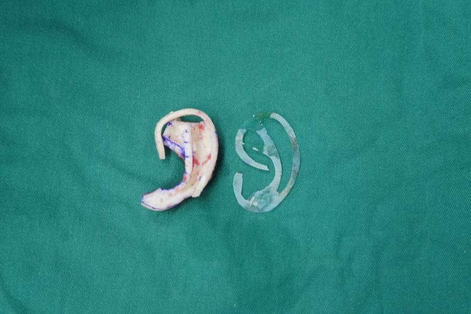 小耳畸形手术失败了还能修复吗,小耳畸形1度有必要手术再造吗