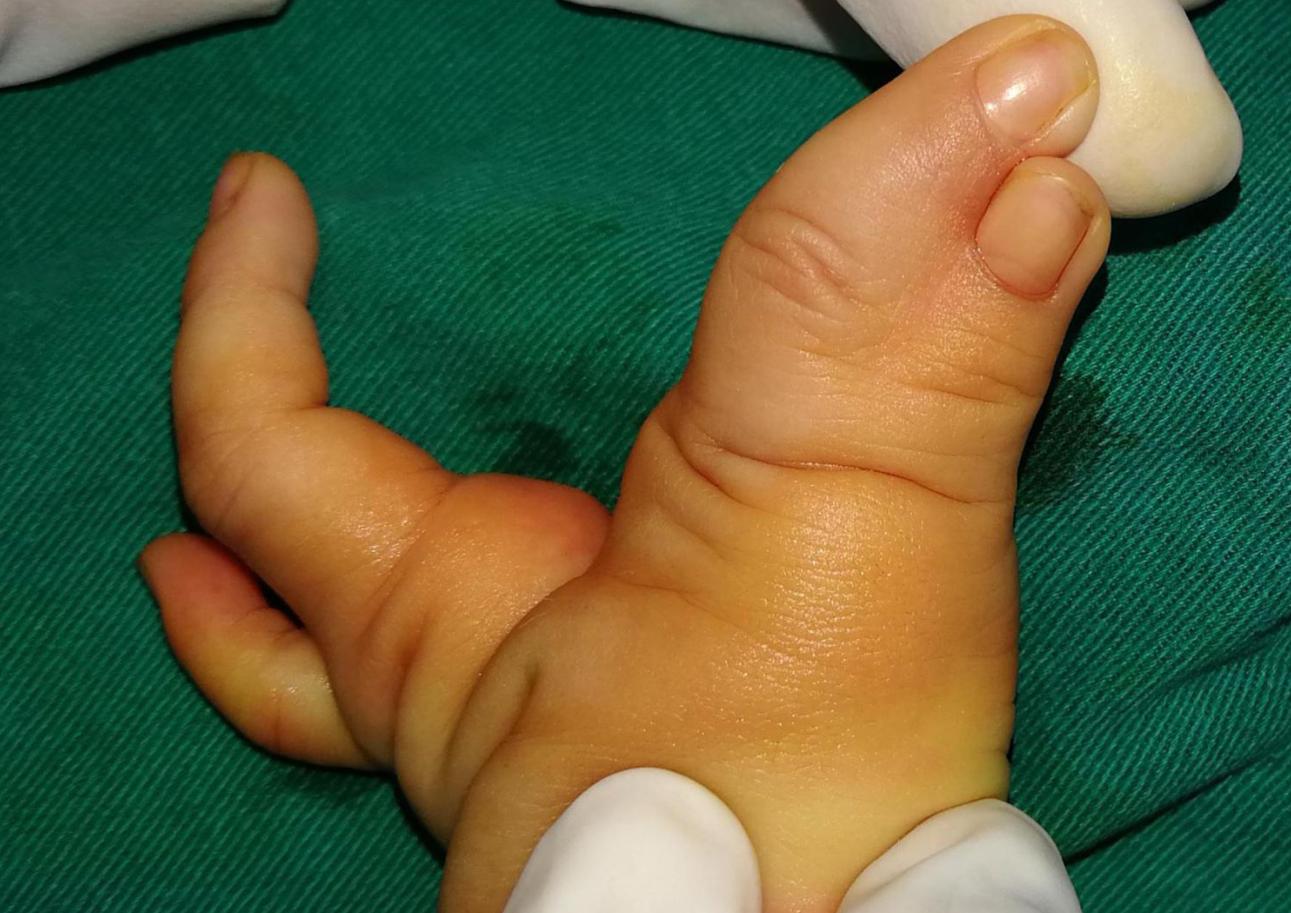 并指畸形免植皮案例,并指畸形