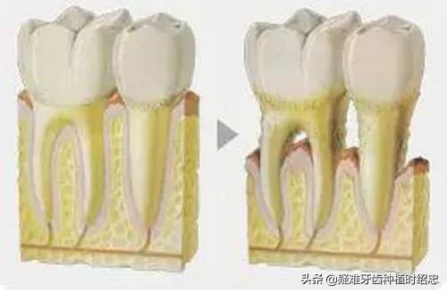 为什么换完牙齿后牙齿还会松动,换过的牙齿松动是什么原因