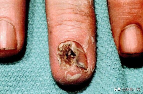 皮肤癌应该如何来护理和预防,皮肤癌的五个小秘诀