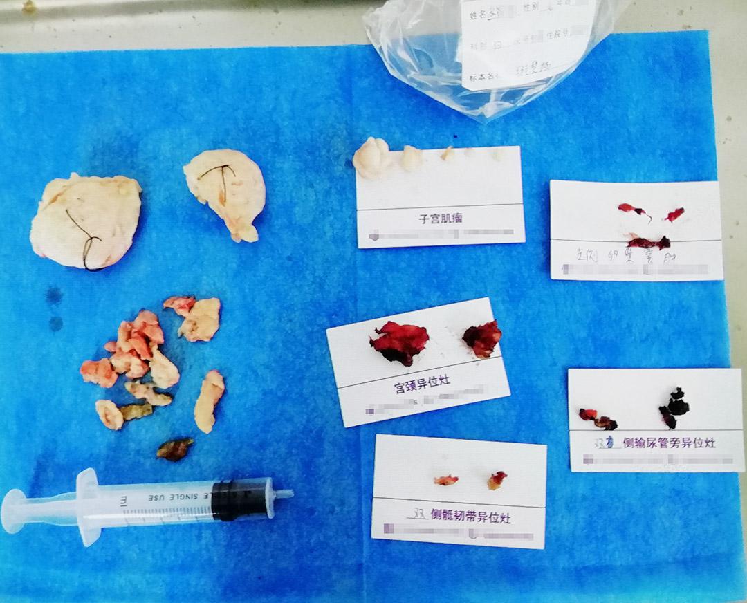 天生的痛经可以做手术根治么,手术根除原发性痛经