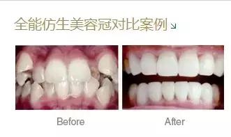 美容冠是什么样,美容冠是什么样的