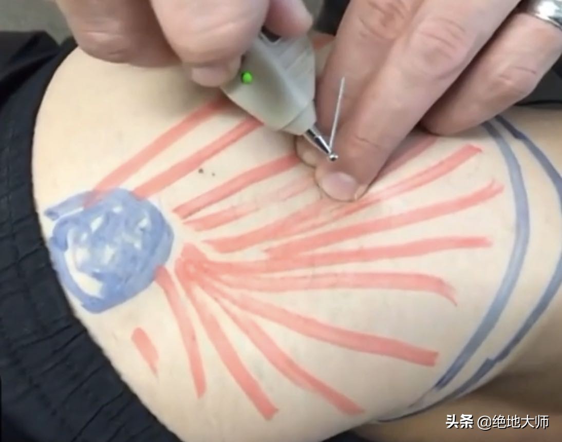 给腰痛的患者康复治疗手法,神经性腰痛哪个穴位治疗