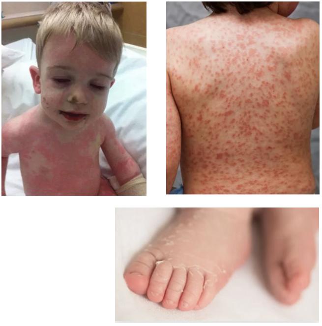 不明原因发热的常见原因及特点,长期不明原因的发热诊治经验