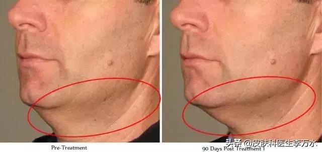 张雨绮说超声刀就像在烤肉?!线雕和超声刀,究竟哪个更靠谱?