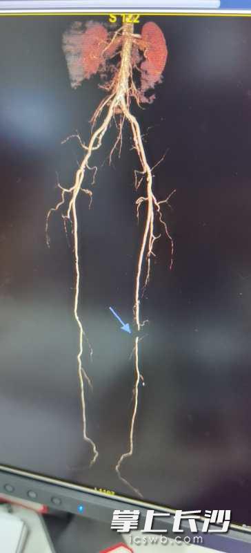 84岁爹爹为什么脚肿,60岁爹爹脚踝肿是怎么回事