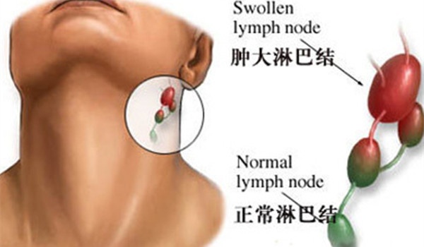 癌症已转移化疗有效吗,癌症有转移还有手术必要吗
