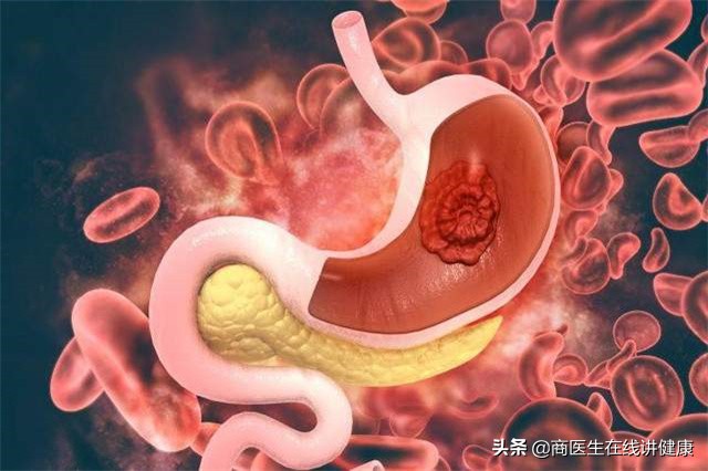 孕期晚上反酸烧心睡不着怎么缓解,中成药左金丸缓解反酸烧心的效果