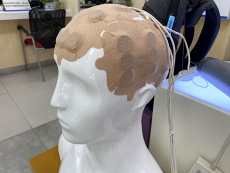 胶质瘤电场疗法临床试验,胶质母细胞瘤有新药吗