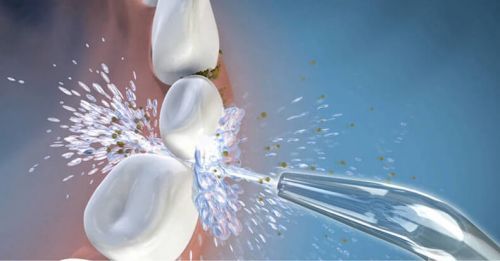 每年去洗一次牙会蛀牙吗,洗完牙医生建议深度清洗有必要吗