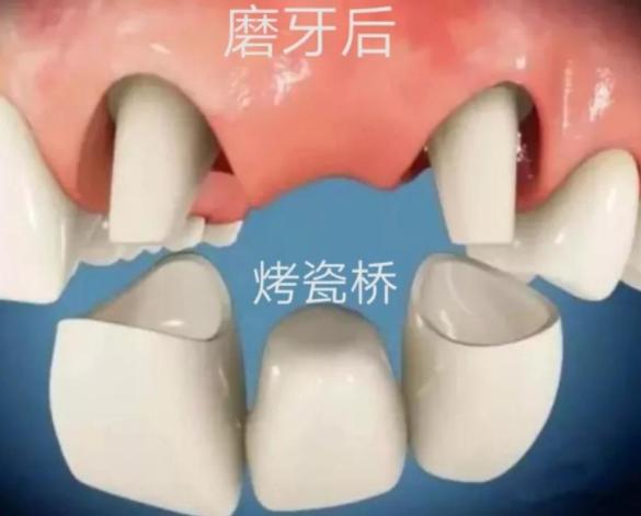 掉了三颗牙能做烤瓷牙吗,被牙医坑做烤瓷牙