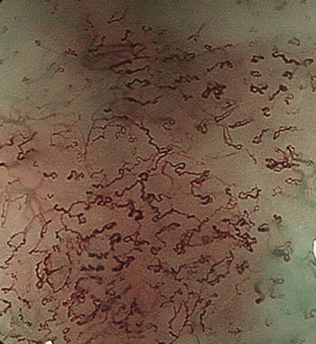 食管癌早期做胃镜能查到吗,食管癌通过胃镜可以检查出来吗