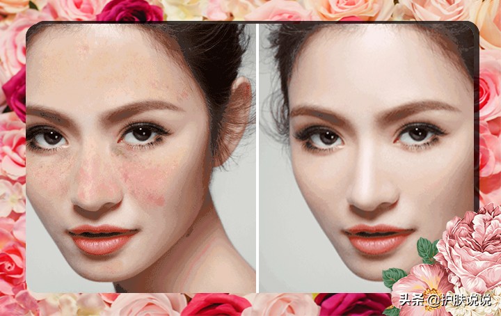 光子嫩肤后怎么快速美白,光子嫩肤和光子美白