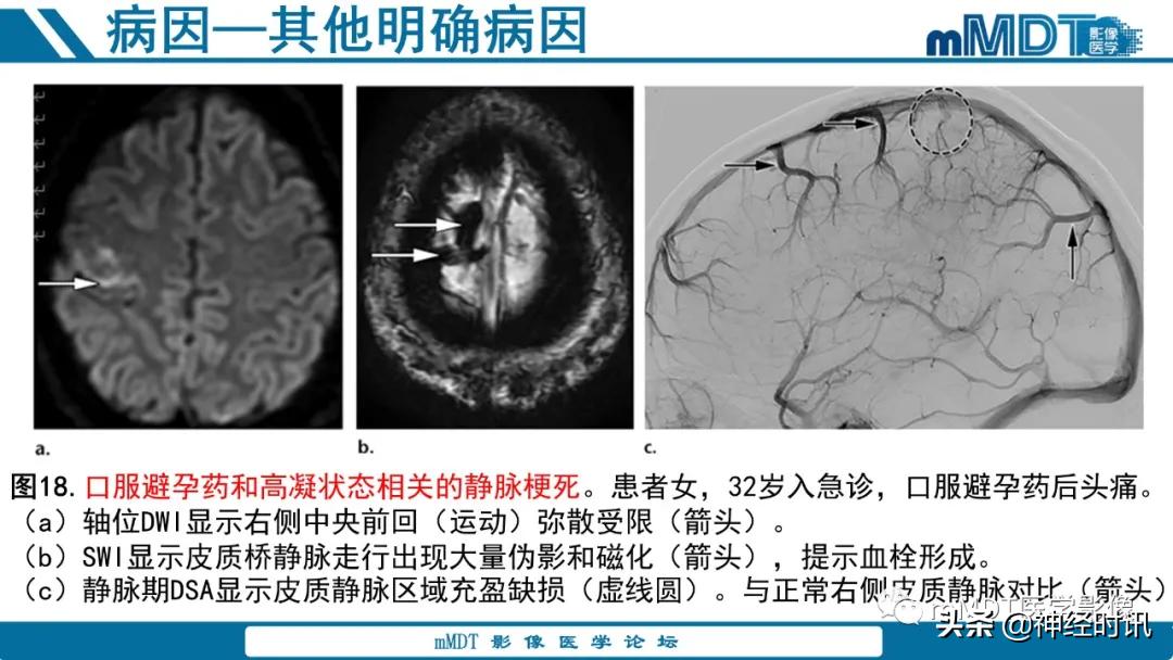 急性缺血性脑卒中ppt素材图片,青年缺血性脑卒中ppt
