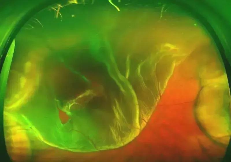 因糖尿病导致的失明怎么诊断,糖尿病眼瞎早期的症状是什么