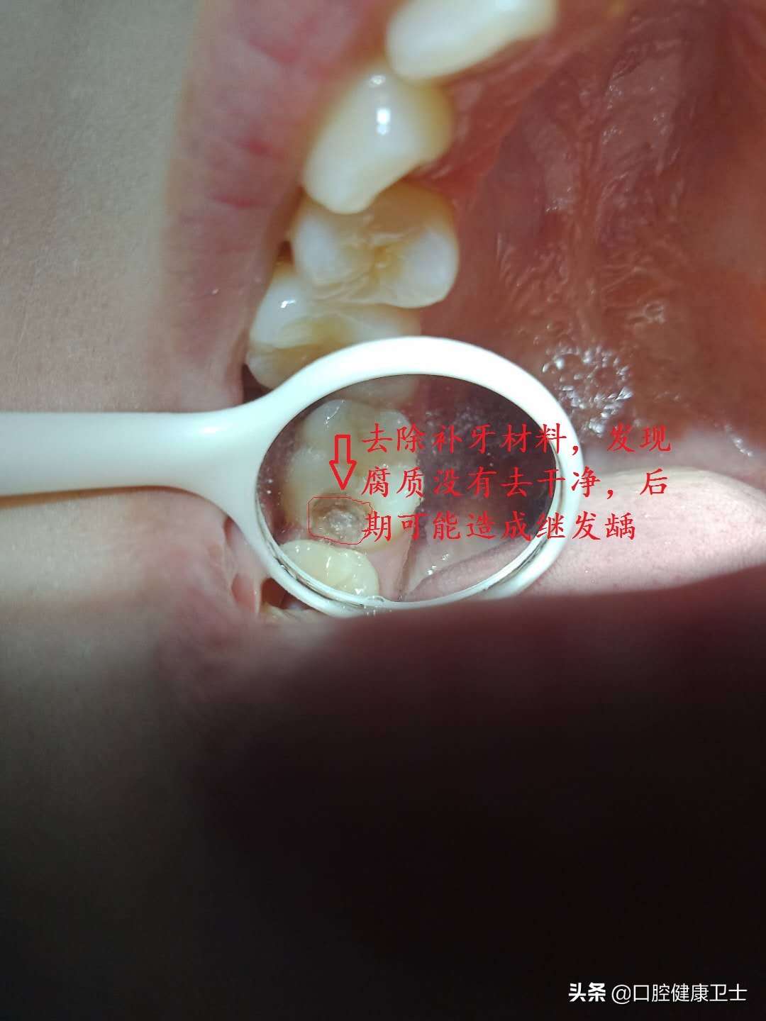 补牙后感觉牙缝被堵上了,补牙后牙缝疼痛是什么原因引起的