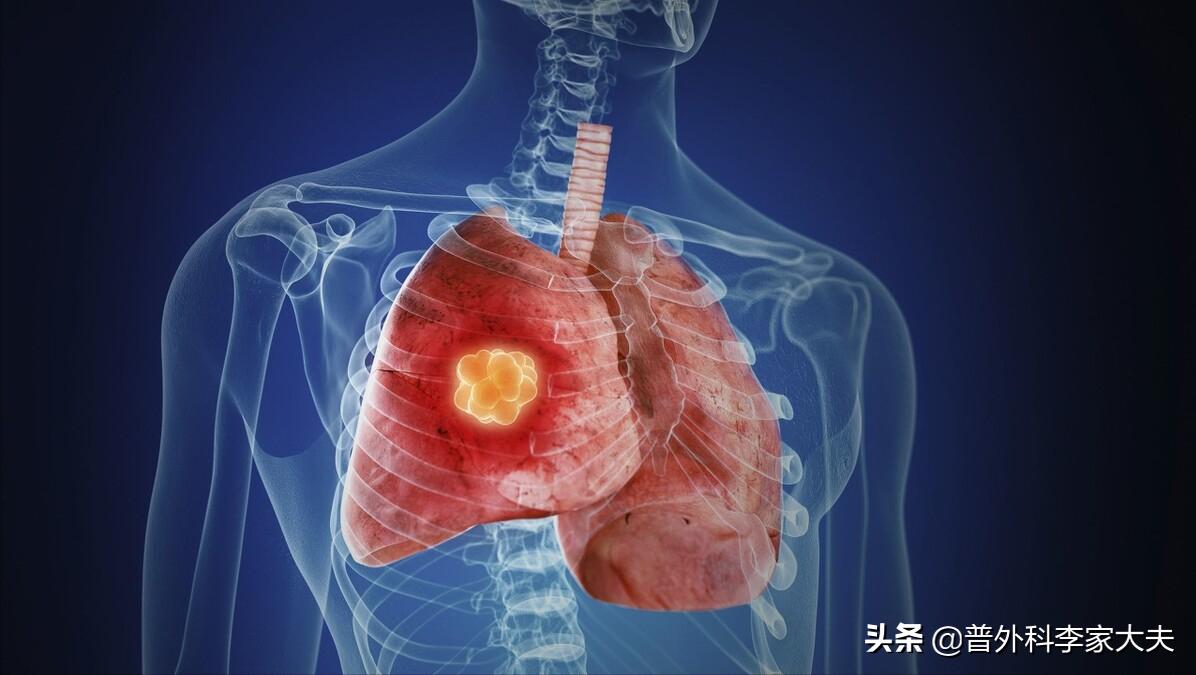 没手术的肺癌患者几年过危险期,没有靶向药的肺癌怎么治疗