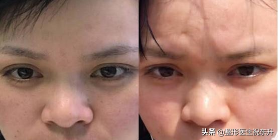 打水光针后的真实感受,水光针注射后1到7天的变化测评