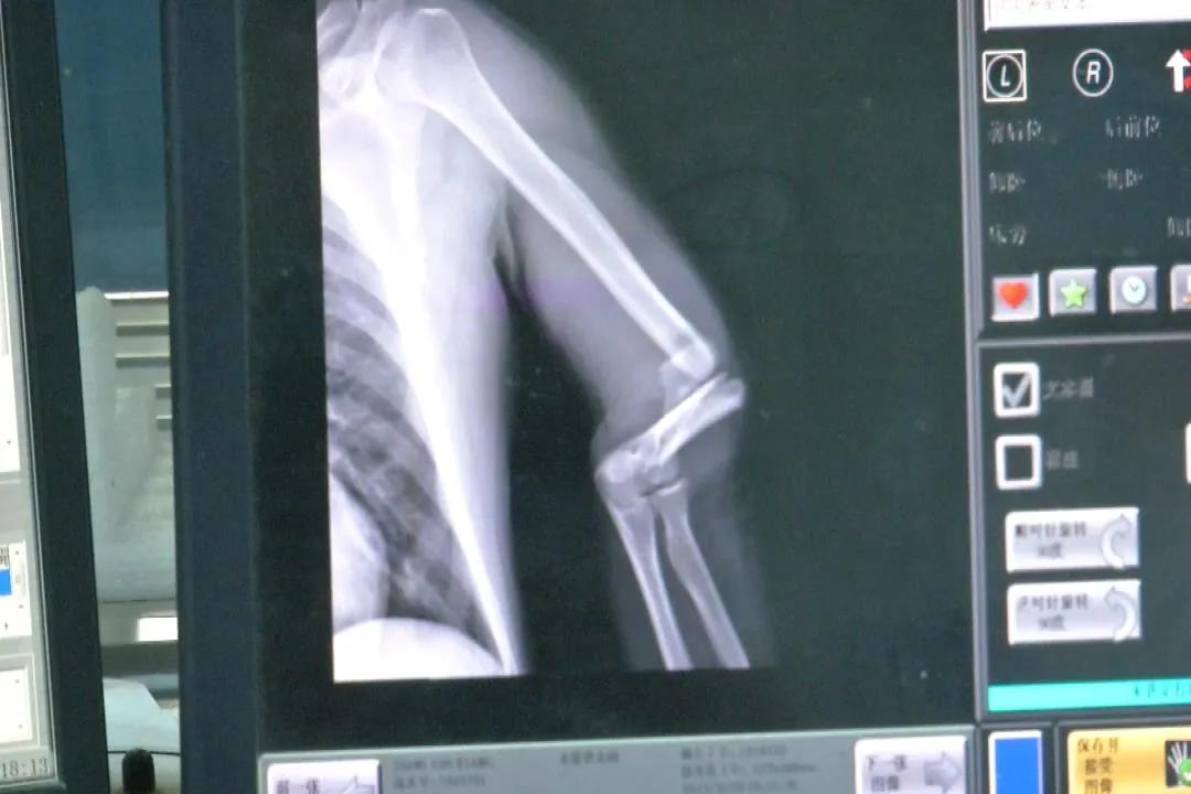 急性胰腺炎发作导致血压降低怎样,胰腺炎伴高血压危险性有多高