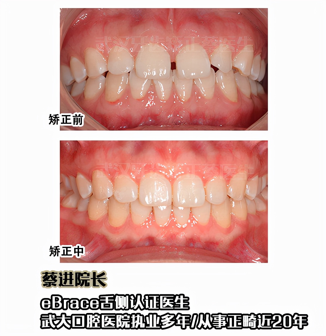 武汉矫正牙齿去哪里做最好,武汉成人牙齿矫正牙齿不齐