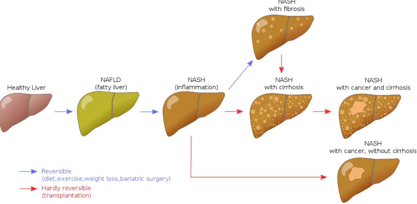 轻视「轻度脂肪肝」的人，后来怎么样了？科学家为此研究51年