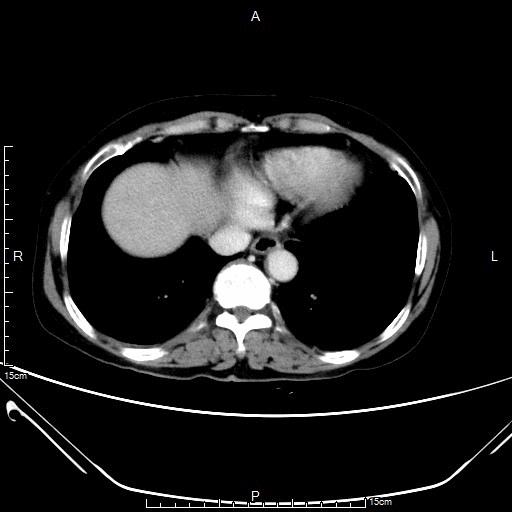 胃癌晚期化疗一次多少钱,胃癌晚期不化疗用靶向药