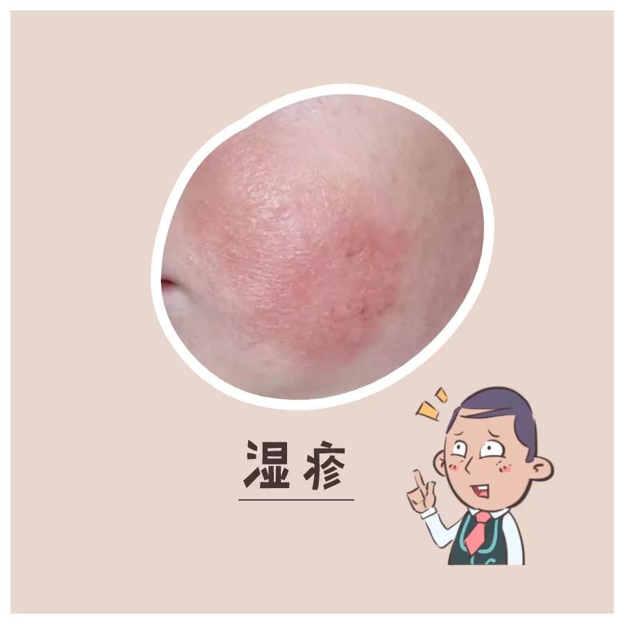 天气热怎么对付痱子,天热起痱子有什么好方法