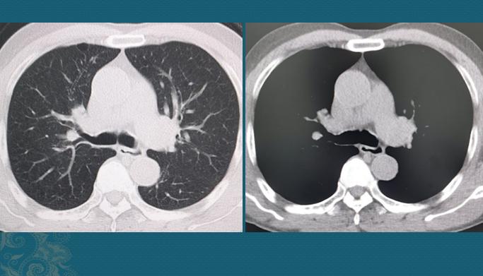 肺癌晚期和肝癌晚期哪个严重,肺癌开始到晚期需要多长时间